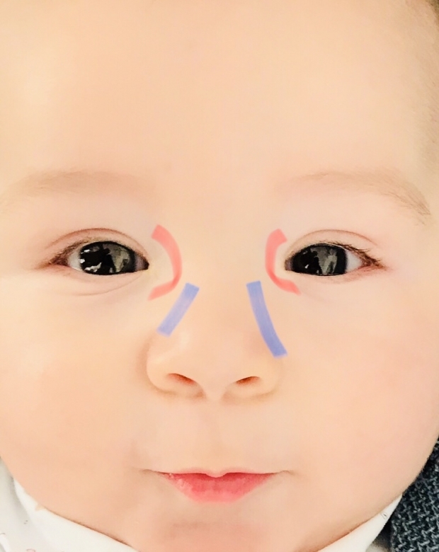 Eye burr massage hos babyer