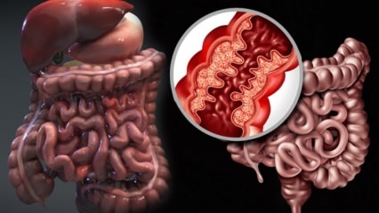 Hva er Crohns sykdom? Hva er symptomene på Crohns sykdom? Er det en kur mot Crohn?