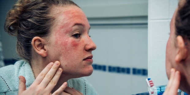 disse vises på huden til en person med en kald allergi