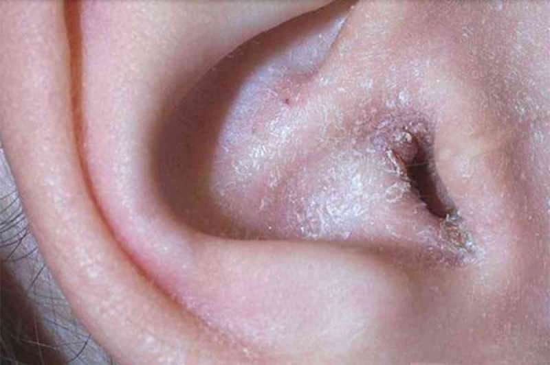 Hva forårsaker peeling bak øret og hvordan passerer det? Den definitive løsningen for eksem bak øret ...