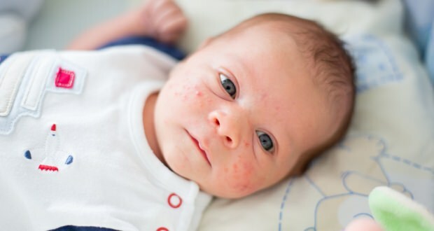 Hvorfor oppstår kviser hos babyer?