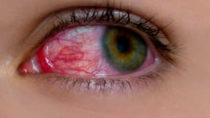 Hva forårsaker øyeallergi? Hva er symptomene på øyeallergi? Hva er bra for øyeallergier? 