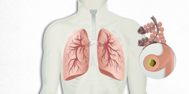 viruset som legger seg i lungene er blandet med lungebetennelse
