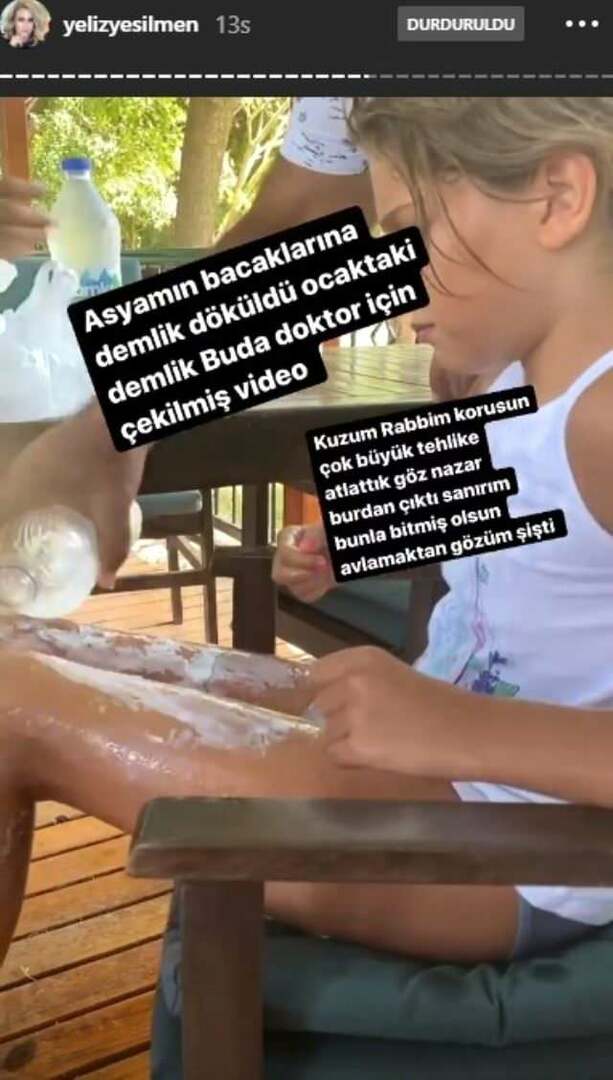 Kokende vann ble helt på Yeliz Yeşilmens datters ben