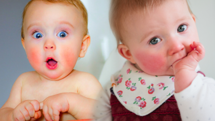 Oppmerksomhet hos babyer med røde kinn! Slapped kinnsyndrom og dets symptomer