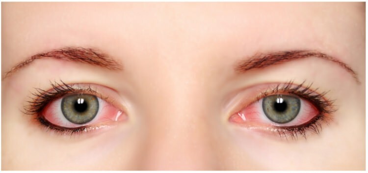 Har mascara og eyeliner allergi i øynene?