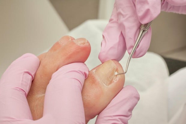 Hva forårsaker inngrodde tånegler og hva er symptomene? Naturlige måter som er bra for inngrodde negler ...