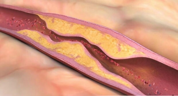 Hva forårsaker aterosklerose? Hvor mange typer vaskulær okklusjon er det?
