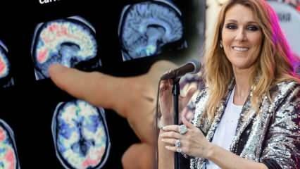 Hva er stiv person-syndrom? Celine Dion