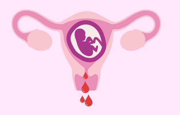 årsaker til blødning under graviditet