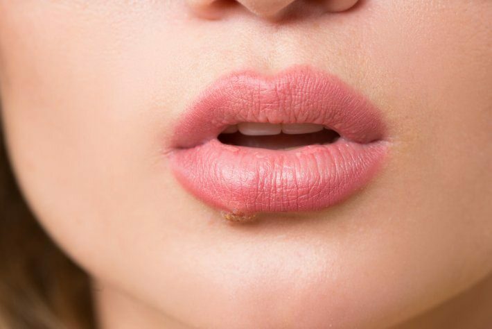 Hva er tungekreft? Hva er symptomene?