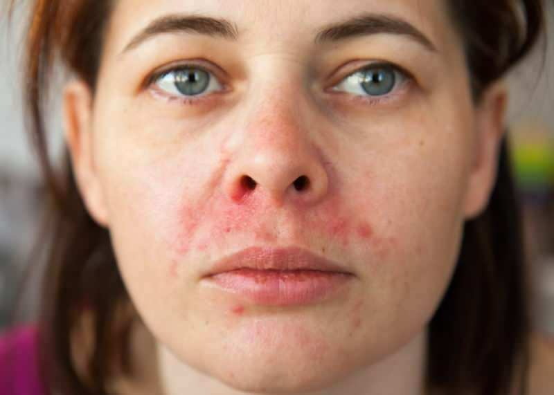 Hvorfor vises kviser rundt leppen? Hvordan behandles perioral dermatitt?