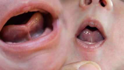 Hva er tungebindingen (Ankyloglossi) hos spedbarn? Tunge bindingssymptomer og behandling ...