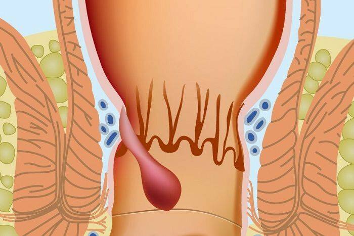 Hvordan hemorroider oppstår i den anale delen 