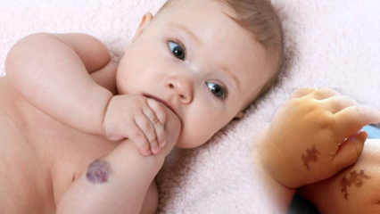 Forårsaker fødselsmerke hos babyer, er det permanent? Hva er typer fødselsmerker? Kurer fra Saracoglu