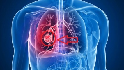 Symptomer på lungekreft: stadier av lungekreft!