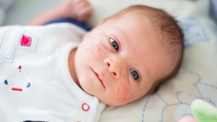 Hvordan går kviser i babyens ansikt? Akne (Milia) tørkemetoder