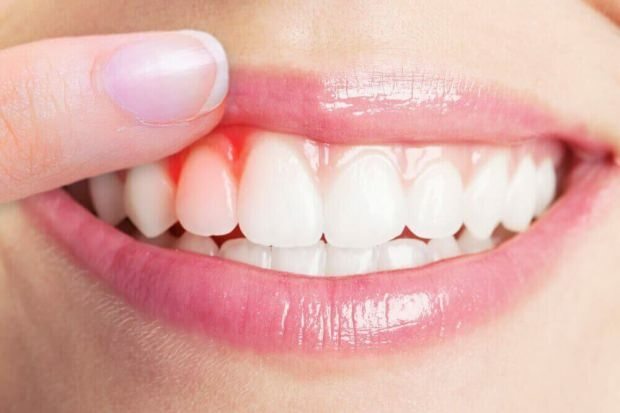 Hva forårsaker blødning i tannkjøttet?