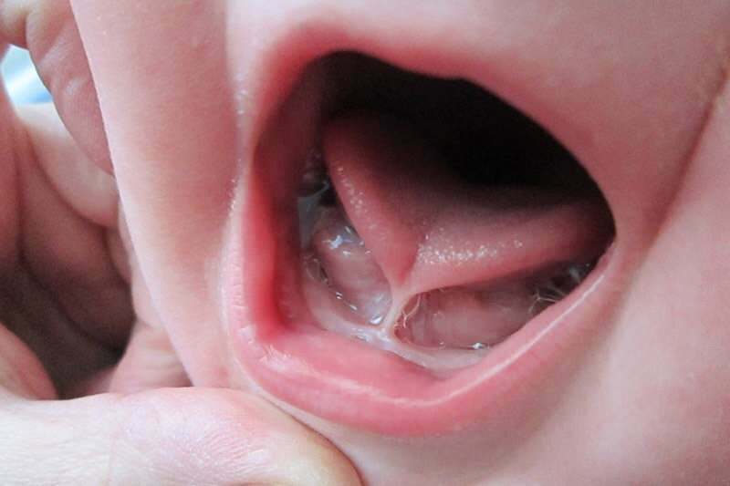 Symptomer og behandling av tungebinding hos spedbarn
