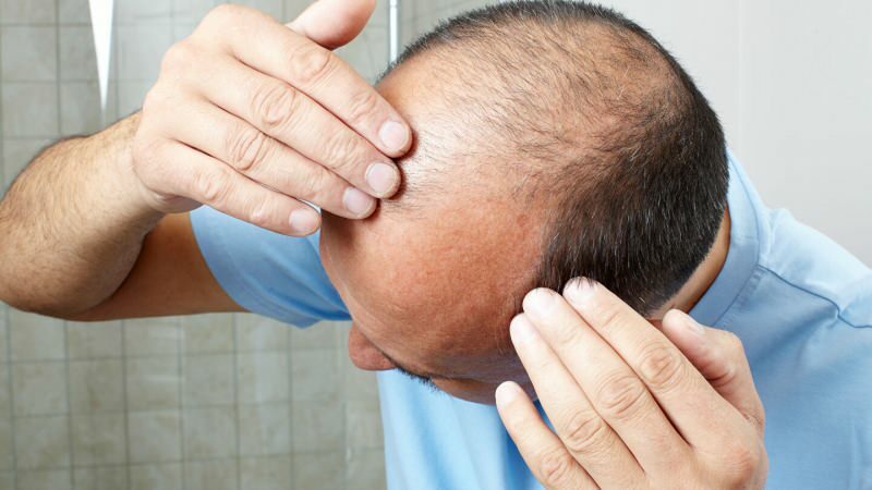 Forebygger hårtransplantasjon ghusl?
