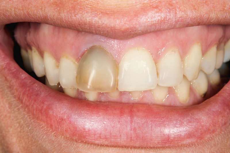 mørkere tenner kan noen ganger konsentrere seg om en tann