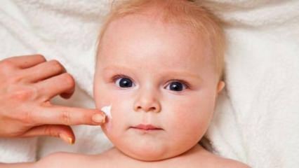 Tips om hudpleie til babyer! Hva er hudproblemene hos babyer?