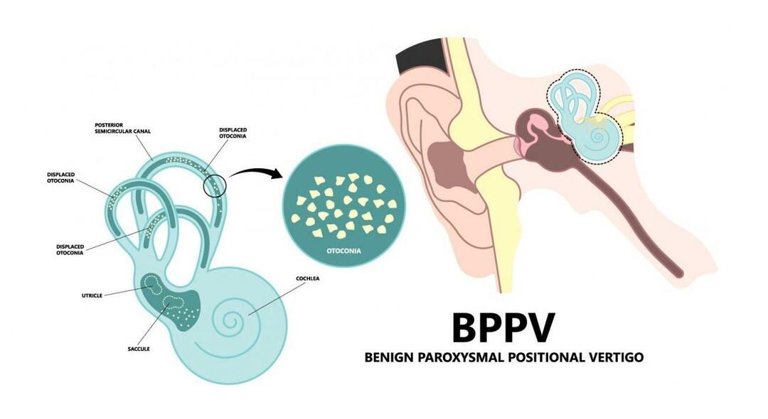 Hvorfor snurrer hodet når du ligger ned? Hva er bra for godartet paroksysmal posisjonsvertigo? Hvordan bli kvitt BPPV