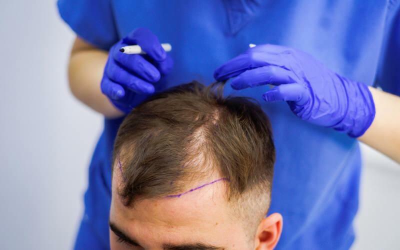 Er det tillatt å transplantere hår i hårtap? Hva er protetisk hår? Hindrer protetisk hår ghusl?