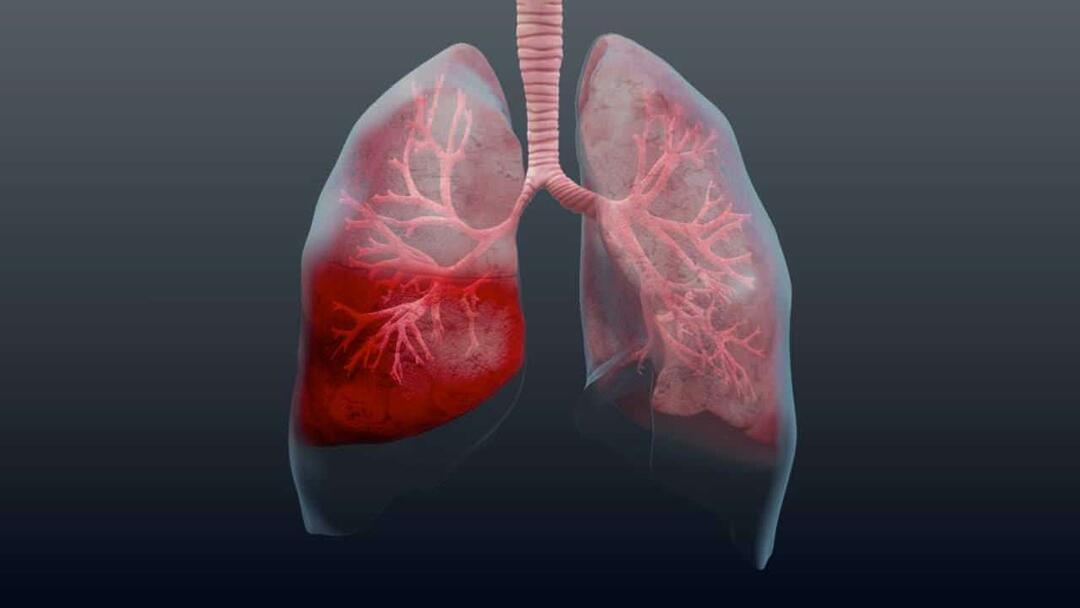 Hva er lungebetennelse og hva er symptomene? Hvordan behandles den nye epidemien Pneumonivirus?