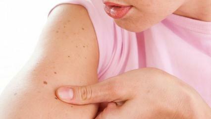 Hva er hudkreft og hva er symptomene? Måter å forstå hudkreft