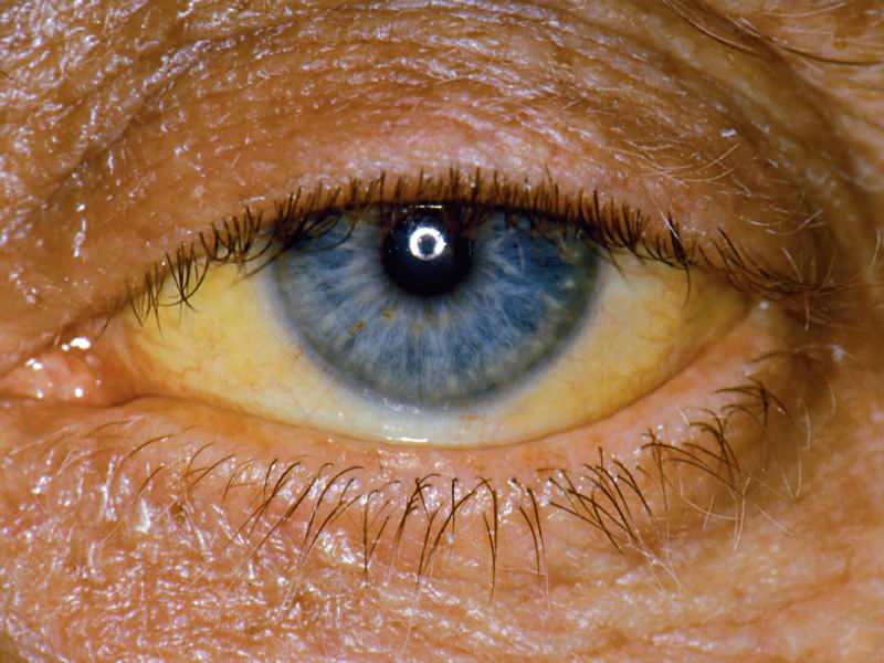 høyde på bilirubinnivå forårsaker gul farge på øyne og hud