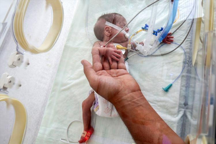 'Miracle baby' klarte å overleve kirurgi