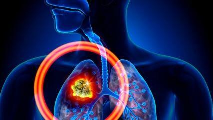 Hva er symptomene på lungekreft? Finnes det en behandling for lungekreft?