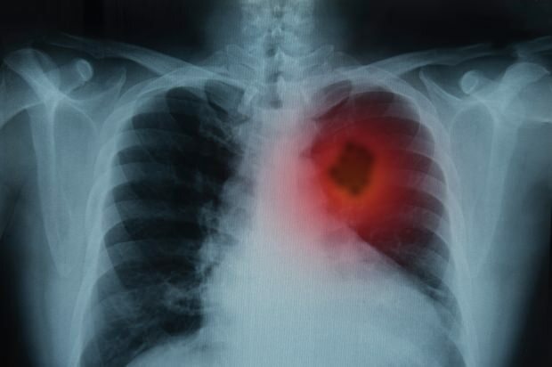 Hva er symptomene på lungekreft? Er det en lungekreftbehandling? For å forhindre lungekreft ...