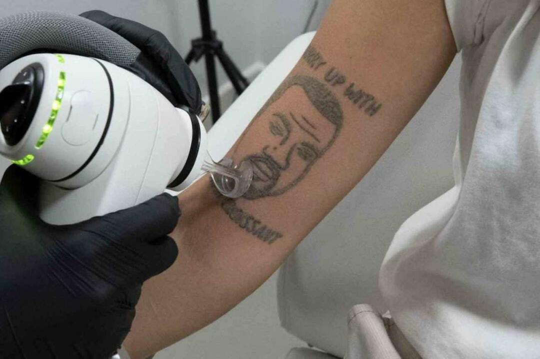 Kanye West-tatoveringen skal fjernes gratis i London 