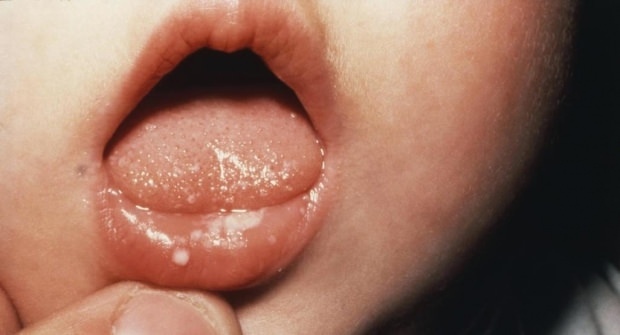 Hvordan vondt i munnen hos babyer