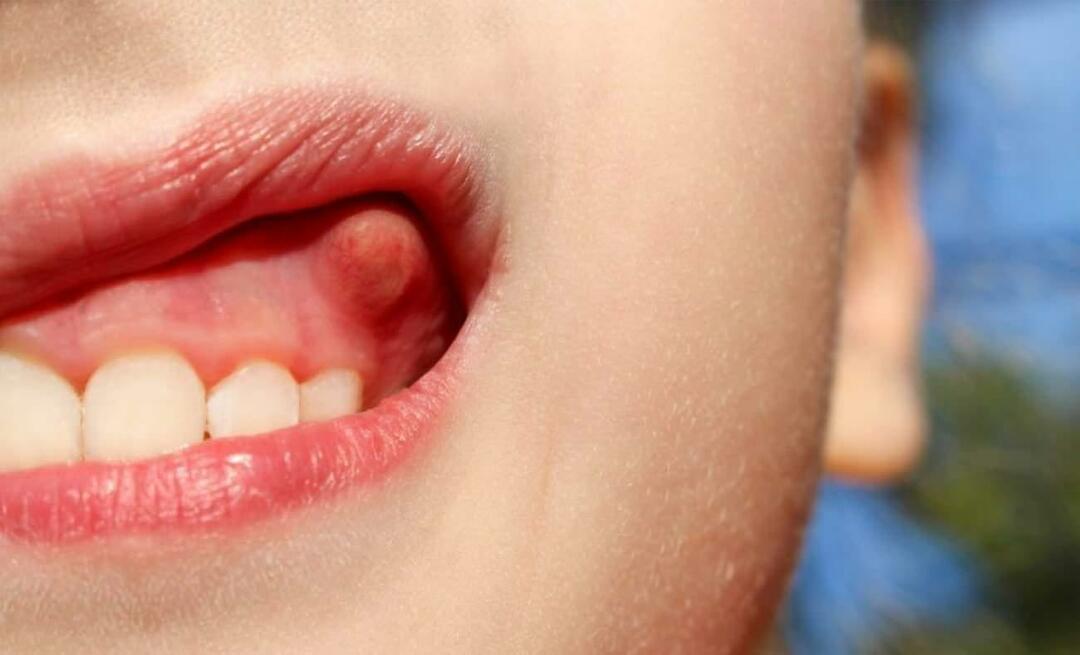 Hvorfor får tannen abscess og hva er symptomene? Tannabscess, hvordan behandles det?