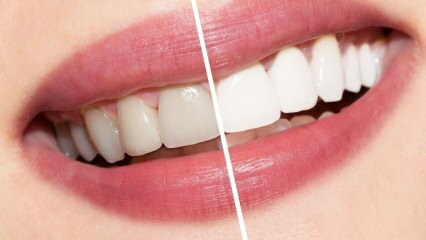 Hva er anbefalingene for hvite tenner? Tannbleking kur naturlig hjemme ...