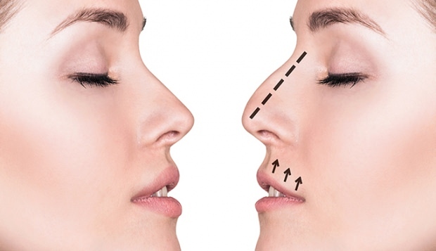Hvordan gjøres en neseoperasjon? I hvilke tilfeller utføres en neseoperasjon?