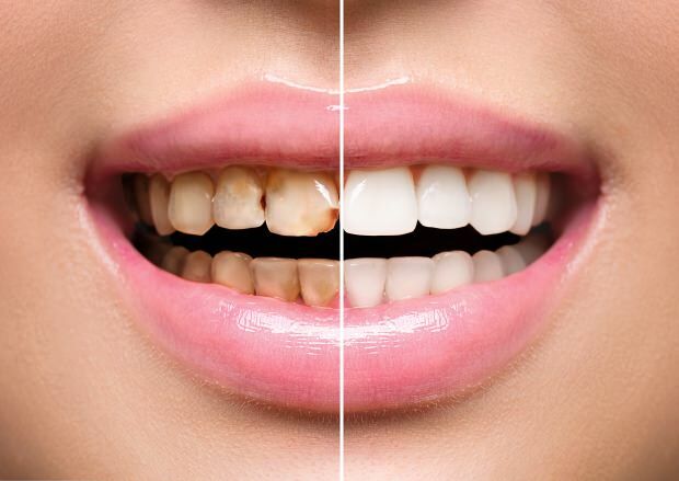 Som et resultat av usunn ernæring, oppstår både tannfarging og tanntap
