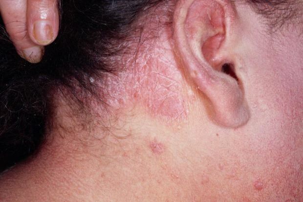 Hva er symptomene på seboreisk dermatitt, og hvem vises den? Mat som utløser sykdommen