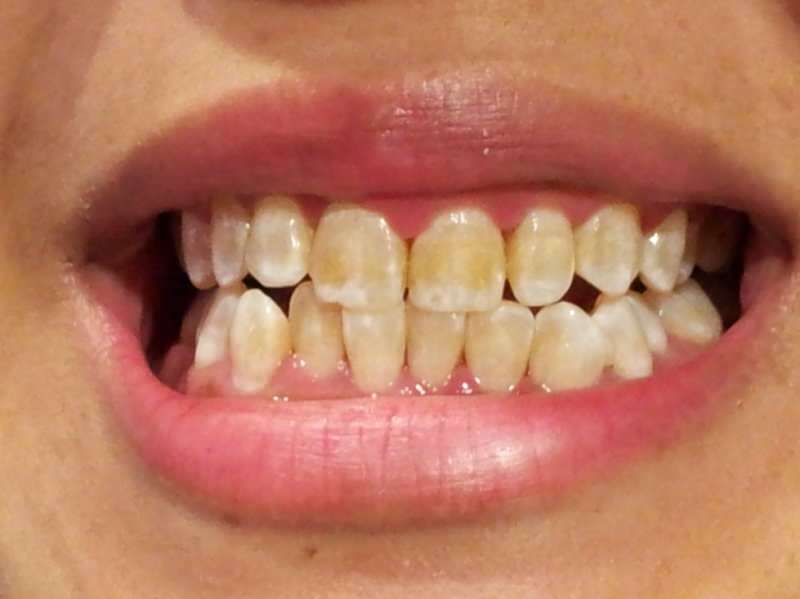 tannbilde av en person hvis tenner begynner å mørkne