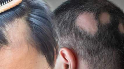 Hva er ringorm (Alopecia areata)? Hva er ringormsymptomer? Effektive løsninger for ringorm