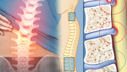 Hva er ryggmargsnevring? Hva er symptomene på innsnevring av ryggmargen? Finnes det en kur for innsnevring av ryggmargen?