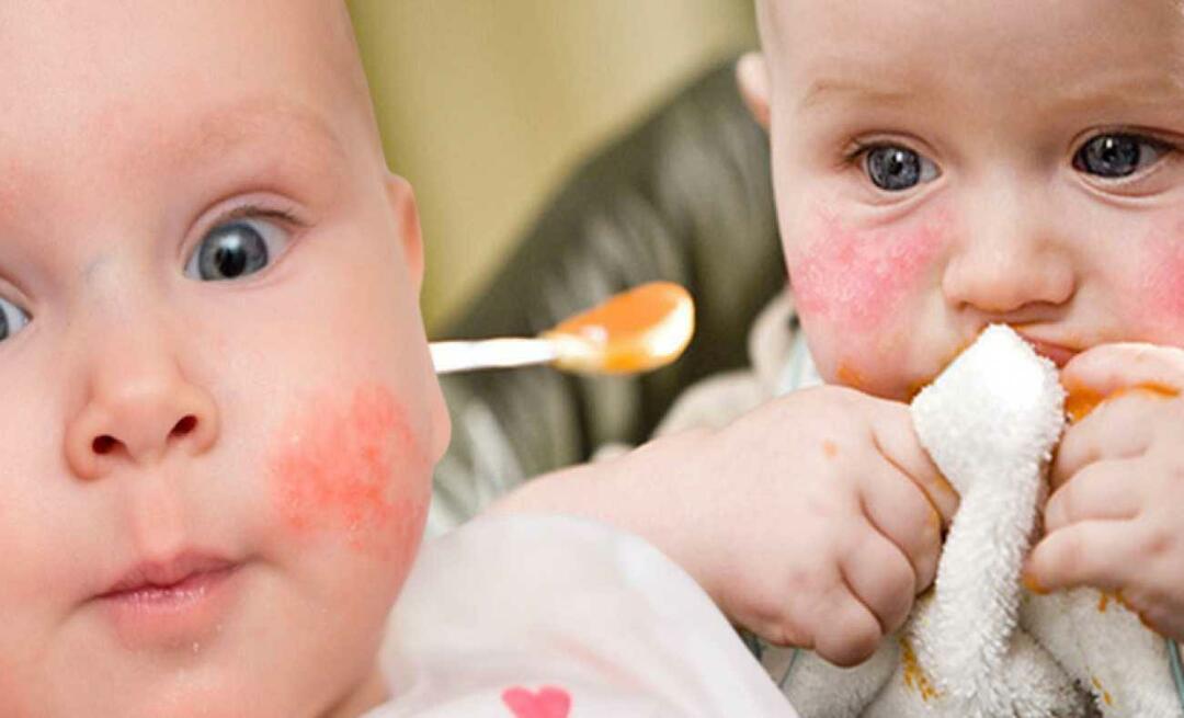 Hva bør en baby med allergi spise? Hva er alternativ mat for allergiske babyer?