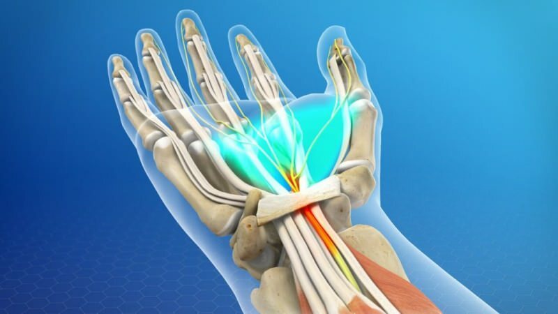 som et resultat av trykk, blir muskelsystemet i håndleddet skadet, noe som forårsaker karpaltunnelsyndrom