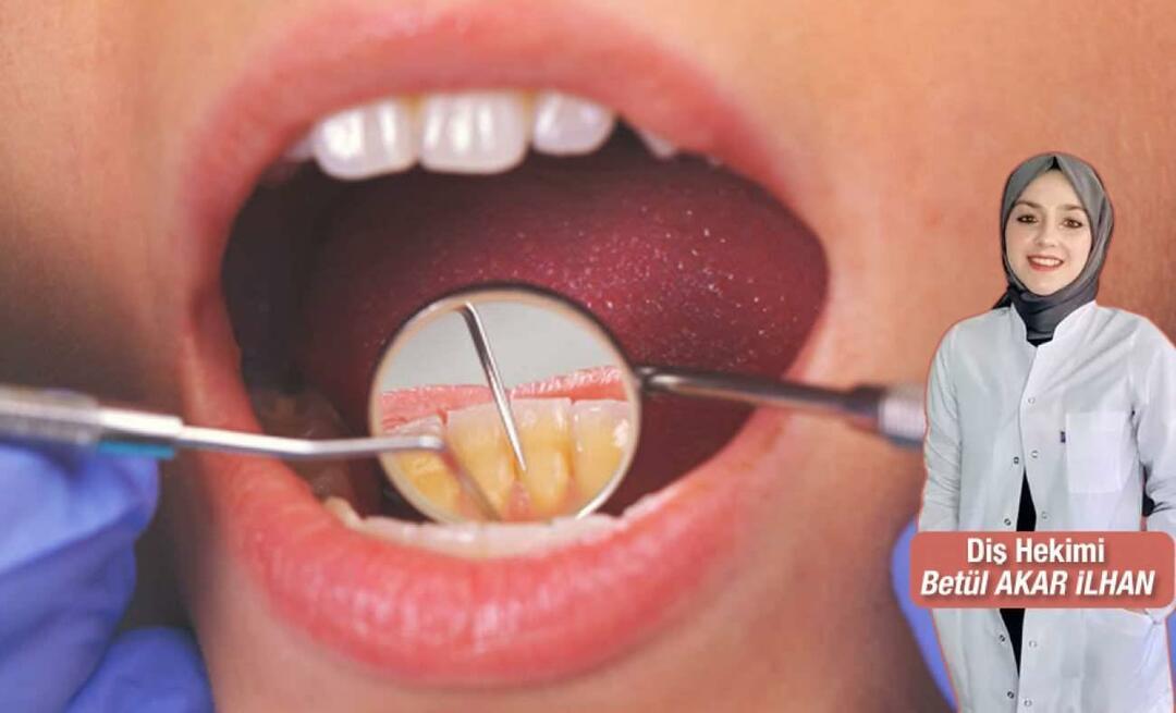 Hva bør gjøres for å unngå tannstein? Hva er fordelene med tannskalering?
