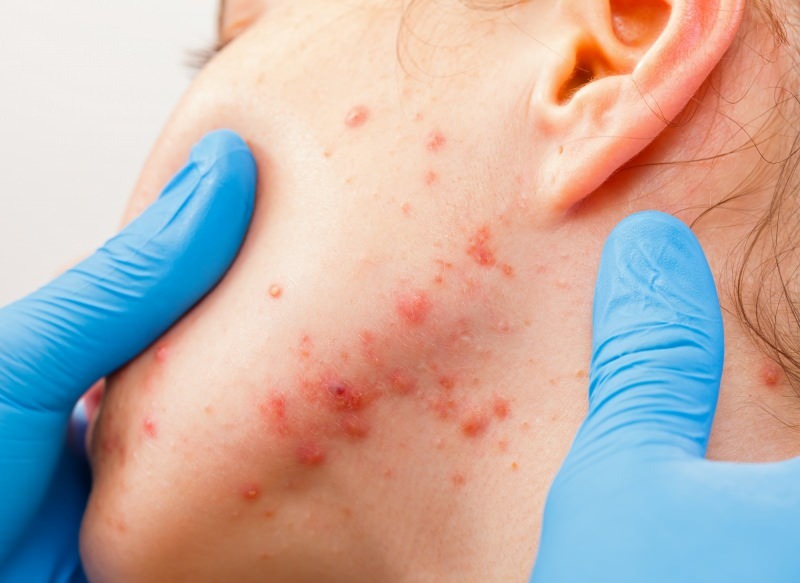 viruset forårsaker blemmer på hudoverflaten