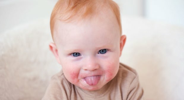 Oppmerksomhet hos babyer med røde kinn! Slapped kinnsyndrom og dets symptomer