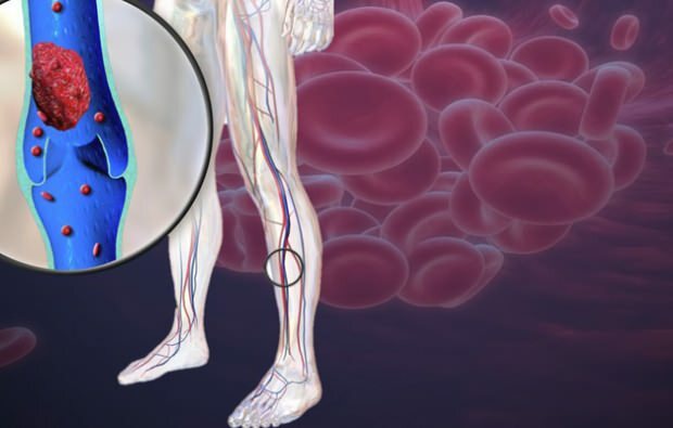 nedsatt blodsirkulasjon i benårene forårsaker smerter